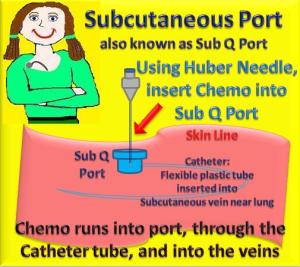 Sub Q Port aka Subcutaneous Port